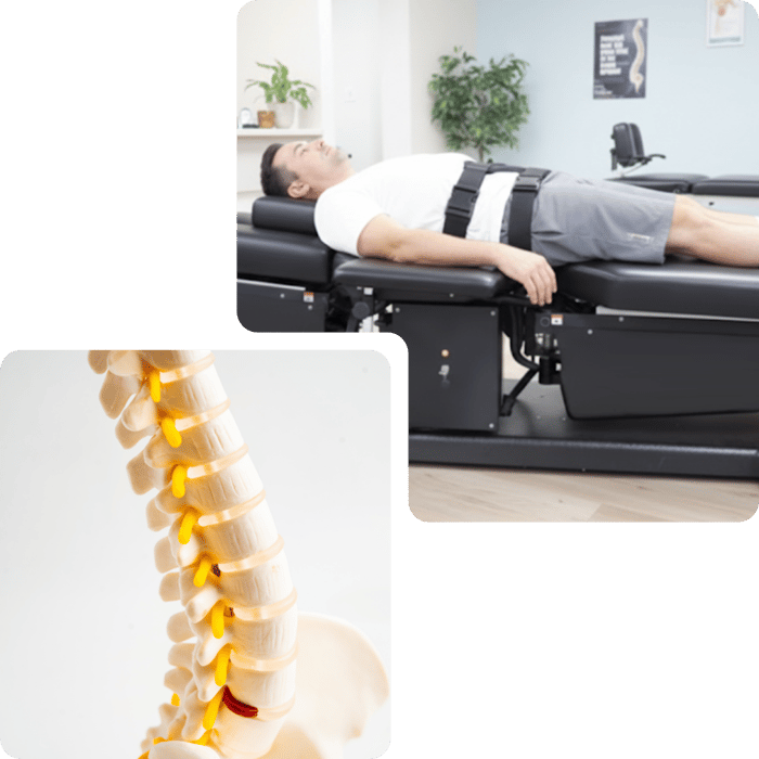 Patient on a spinal decompression table beside a model of the human spine